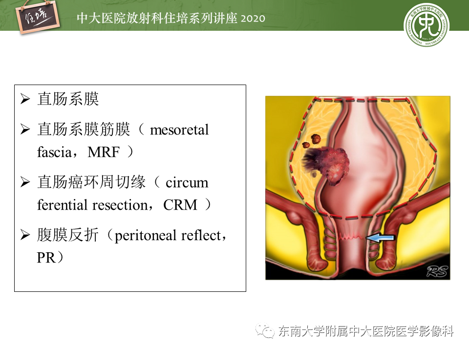 影像PPT - 【PPT】直肠癌影像临床分期注意事项-9