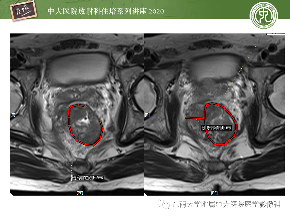 影像PPT - 【PPT】直肠癌影像临床分期注意事项-12