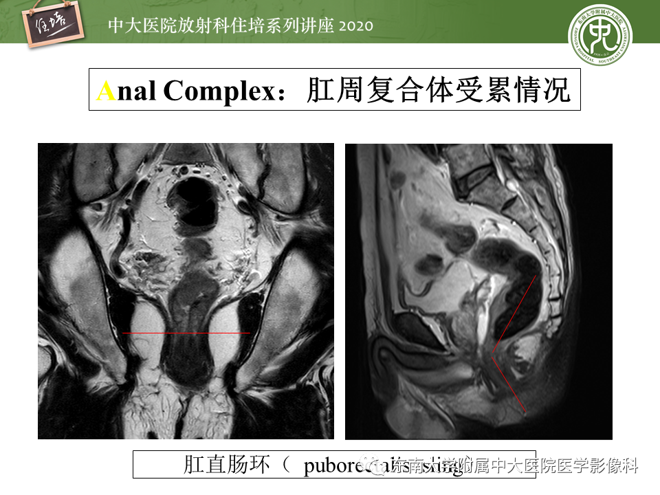 影像PPT - 【PPT】直肠癌影像临床分期注意事项-13