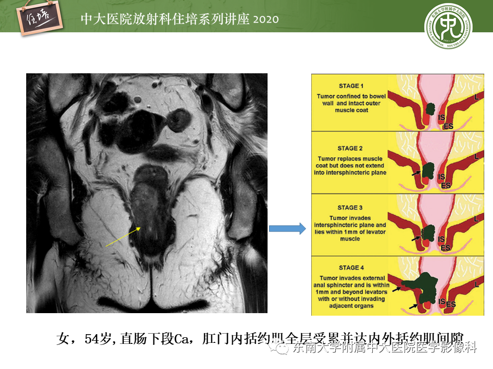 影像PPT - 【PPT】直肠癌影像临床分期注意事项-14