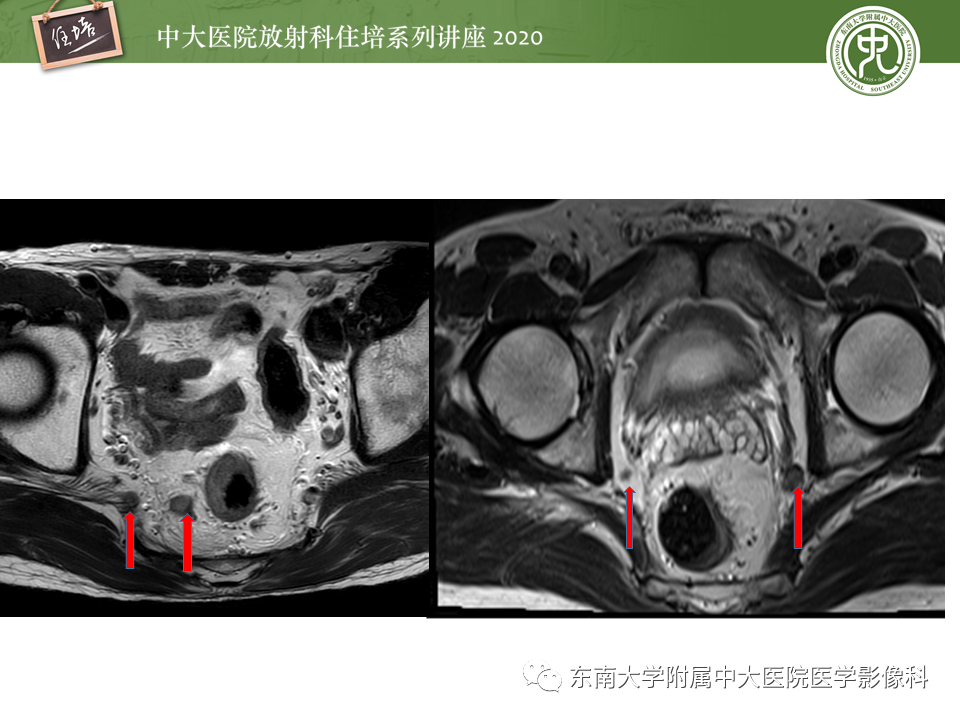 影像PPT - 【PPT】直肠癌影像临床分期注意事项-16