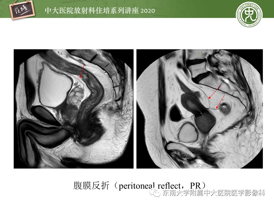 影像PPT - 【PPT】直肠癌影像临床分期注意事项-11