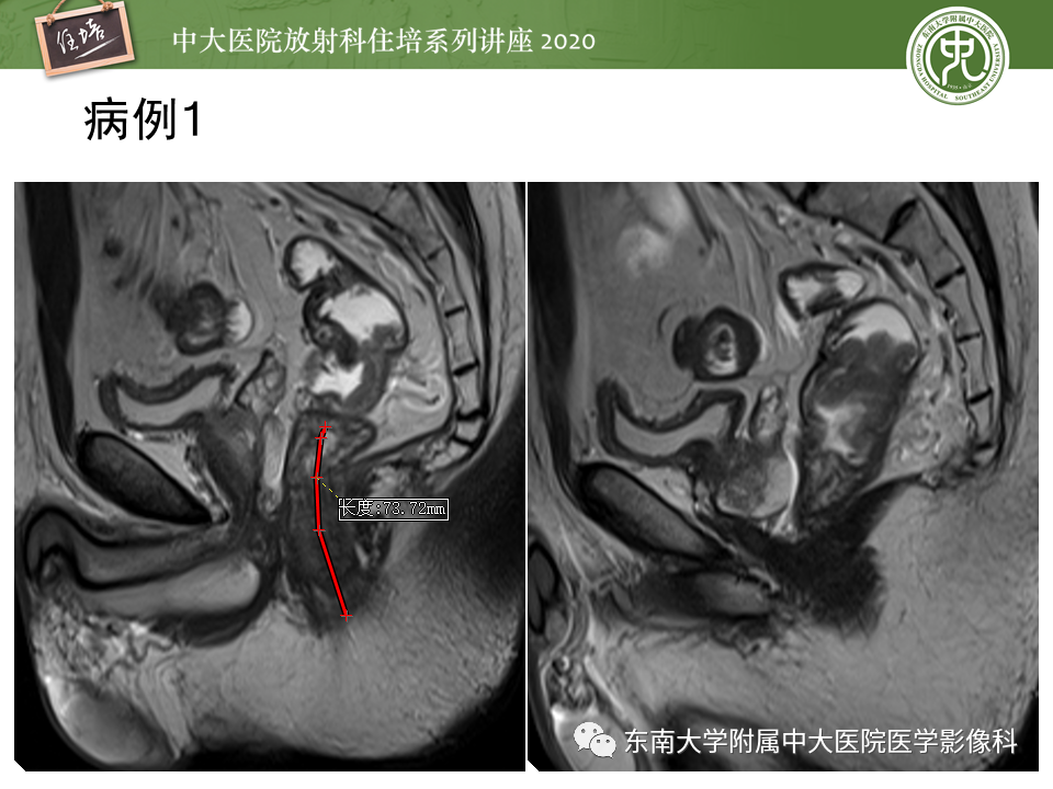 影像PPT - 【PPT】直肠癌影像临床分期注意事项-20