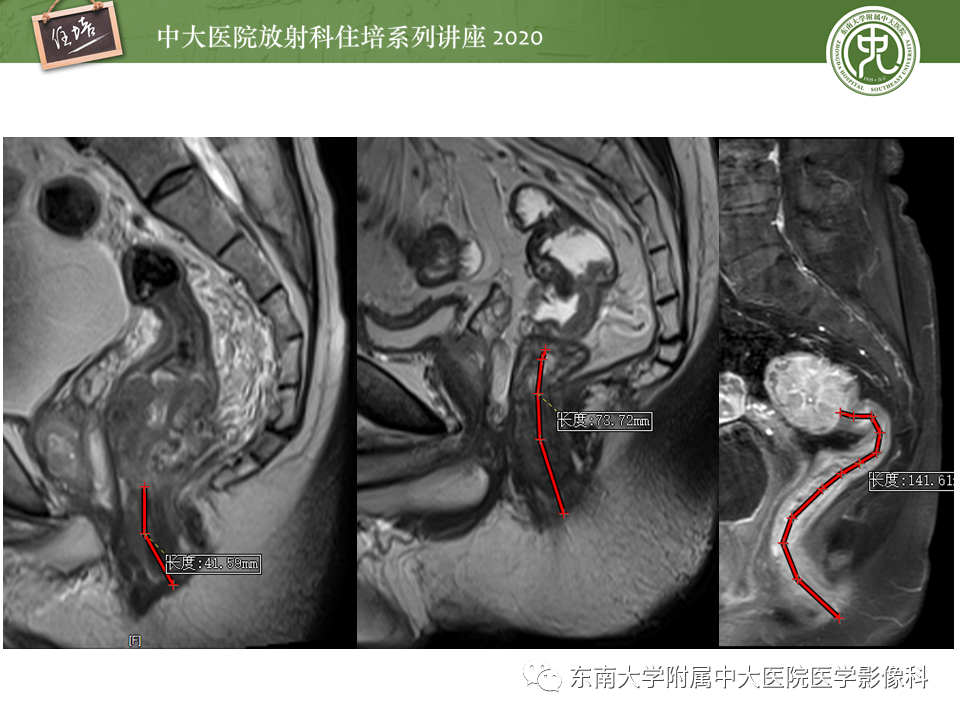 影像PPT - 【PPT】直肠癌影像临床分期注意事项-7