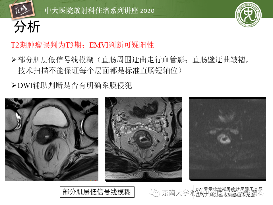 影像PPT - 【PPT】直肠癌影像临床分期注意事项-24