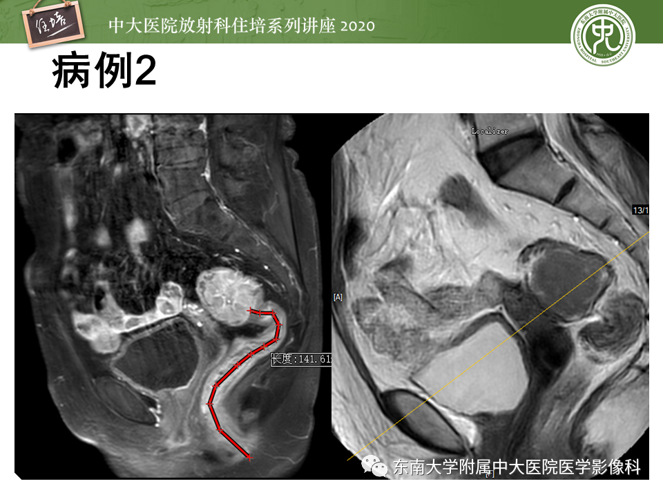 影像PPT - 【PPT】直肠癌影像临床分期注意事项-25