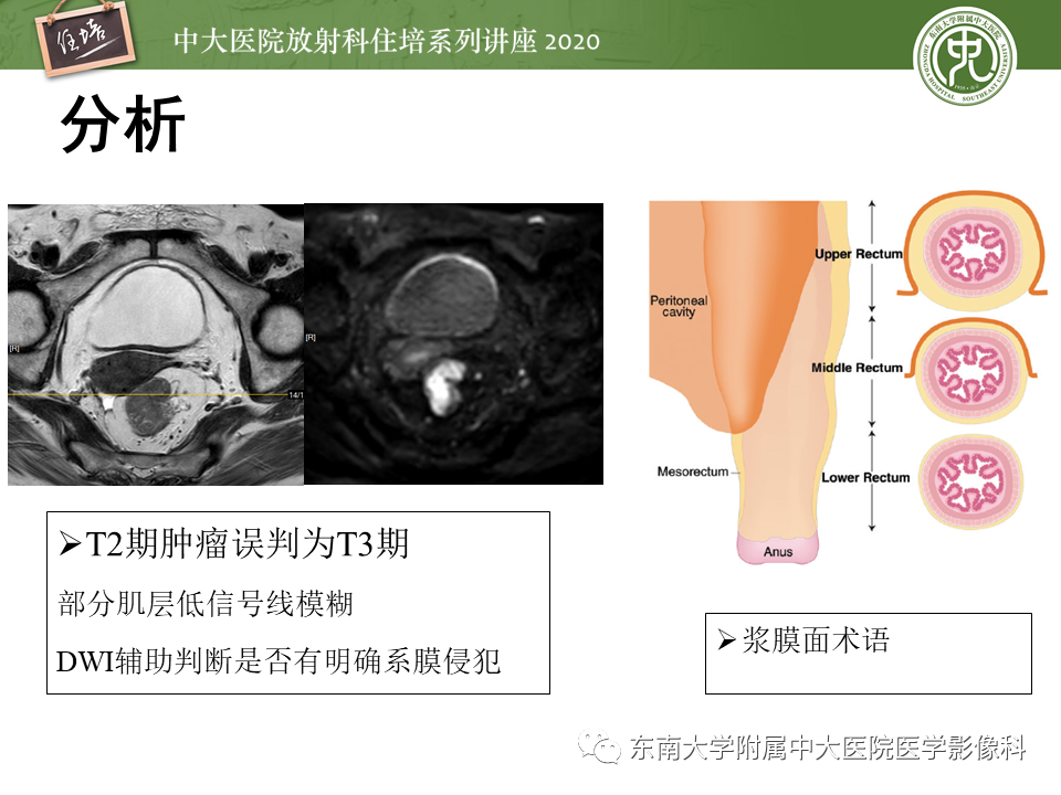 影像PPT - 【PPT】直肠癌影像临床分期注意事项-28