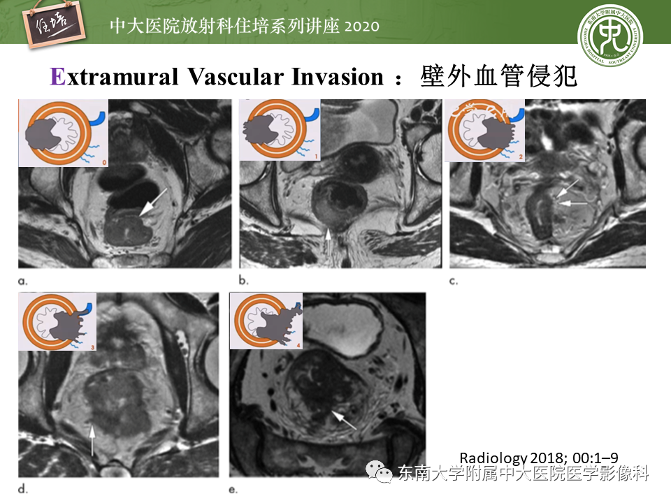 影像PPT - 【PPT】直肠癌影像临床分期注意事项-18