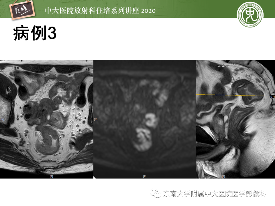影像PPT - 【PPT】直肠癌影像临床分期注意事项-29