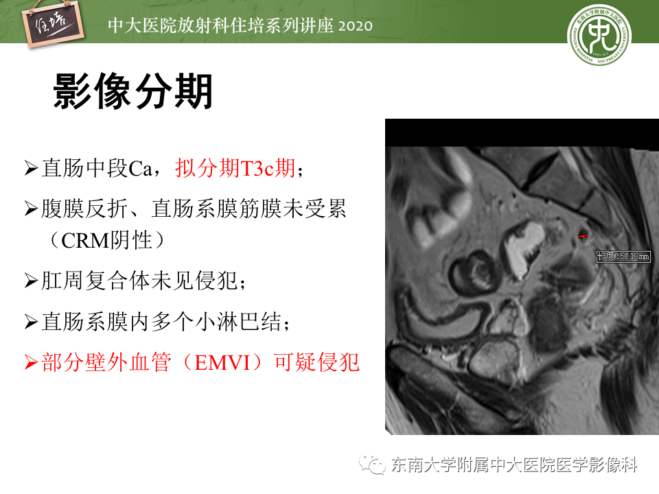 影像PPT - 【PPT】直肠癌影像临床分期注意事项-22