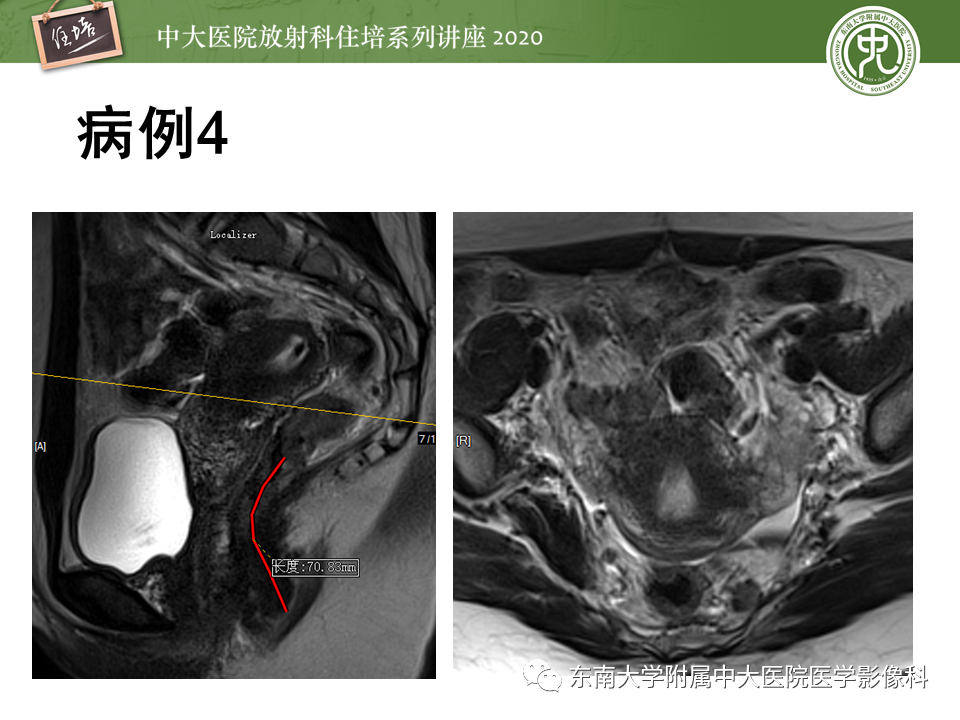 影像PPT - 【PPT】直肠癌影像临床分期注意事项-31