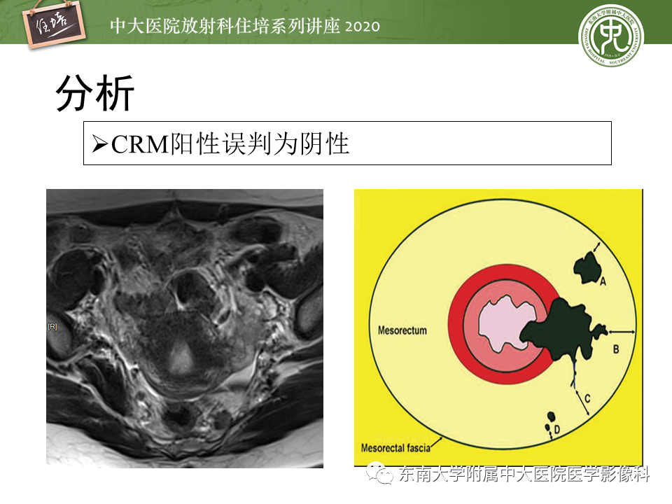 影像PPT - 【PPT】直肠癌影像临床分期注意事项-33