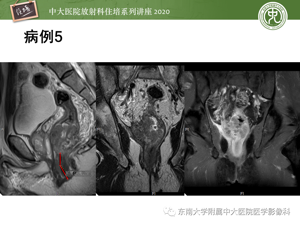 影像PPT - 【PPT】直肠癌影像临床分期注意事项-34