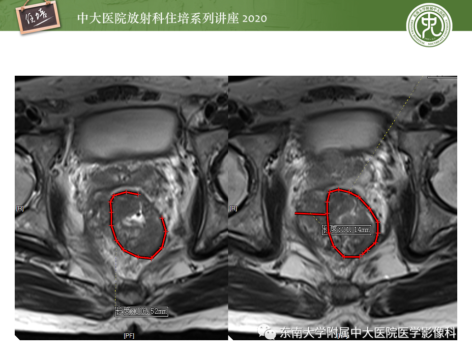 影像PPT - 【PPT】直肠癌影像临床分期注意事项-35