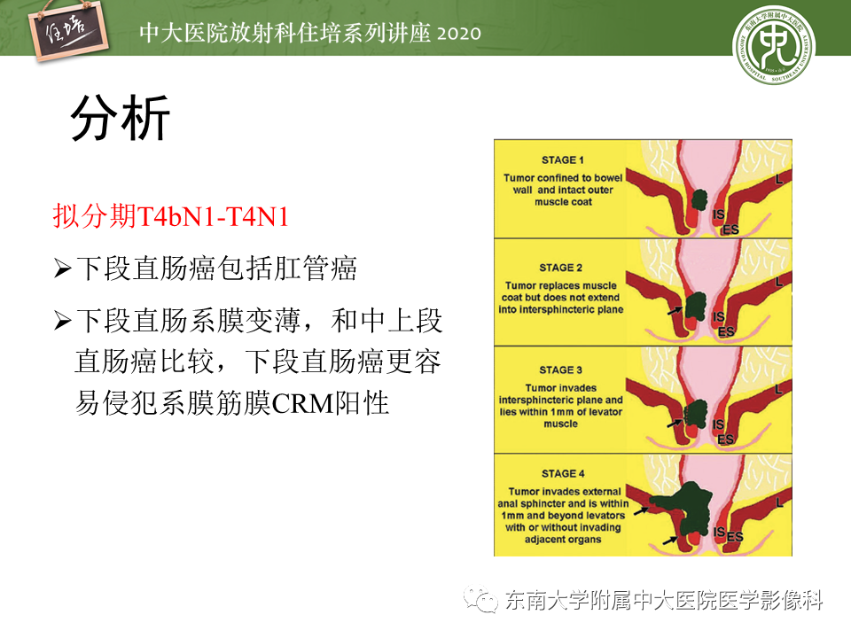 影像PPT - 【PPT】直肠癌影像临床分期注意事项-37