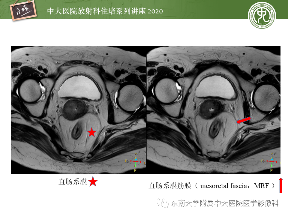 影像PPT - 【PPT】直肠癌影像临床分期注意事项-1