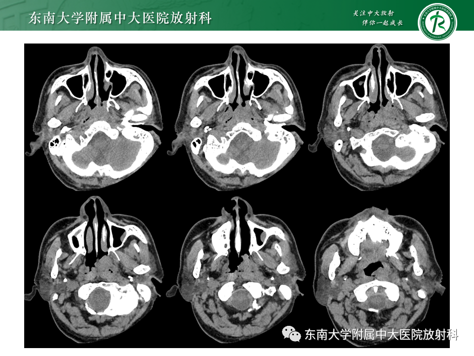 影像PPT - 【PPT】鼻咽部占位性病变随访及鉴别-4