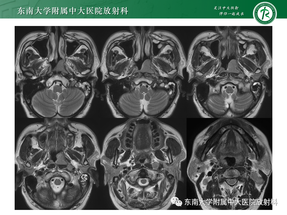 影像PPT - 【PPT】鼻咽部占位性病变随访及鉴别-10