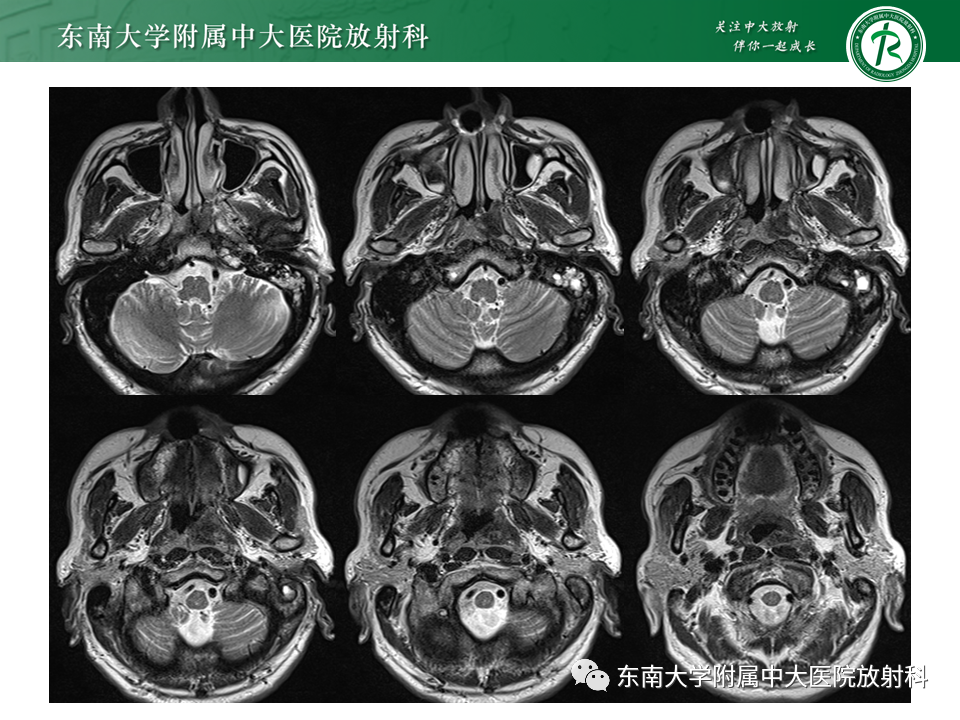 影像PPT - 【PPT】鼻咽部占位性病变随访及鉴别-6