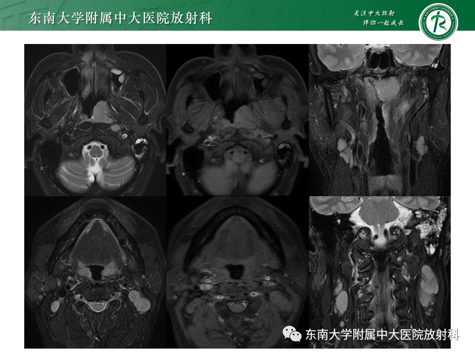影像PPT - 【PPT】鼻咽部占位性病变随访及鉴别-11