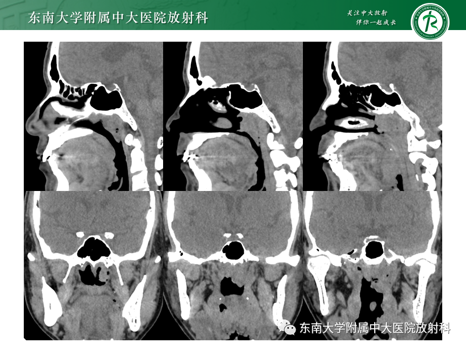 影像PPT - 【PPT】鼻咽部占位性病变随访及鉴别-5