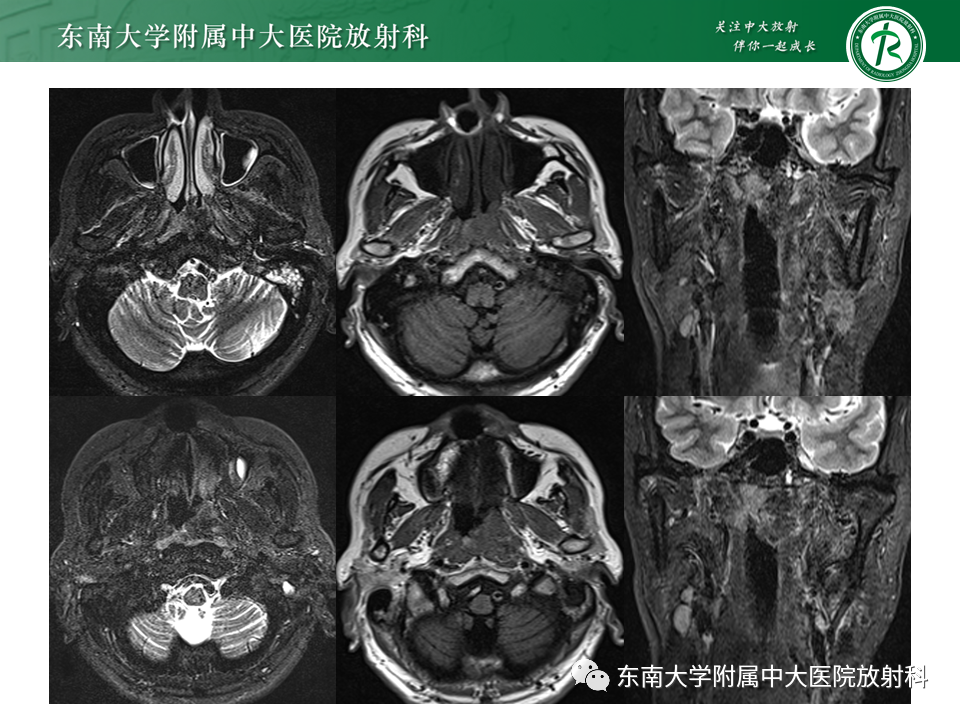 影像PPT - 【PPT】鼻咽部占位性病变随访及鉴别-7