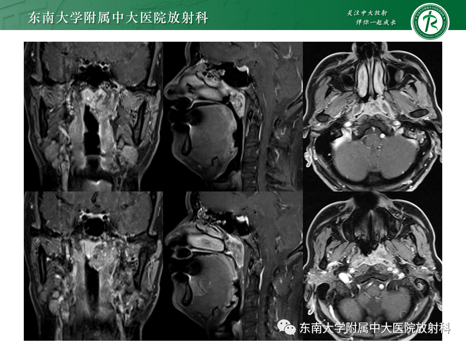 影像PPT - 【PPT】鼻咽部占位性病变随访及鉴别-8