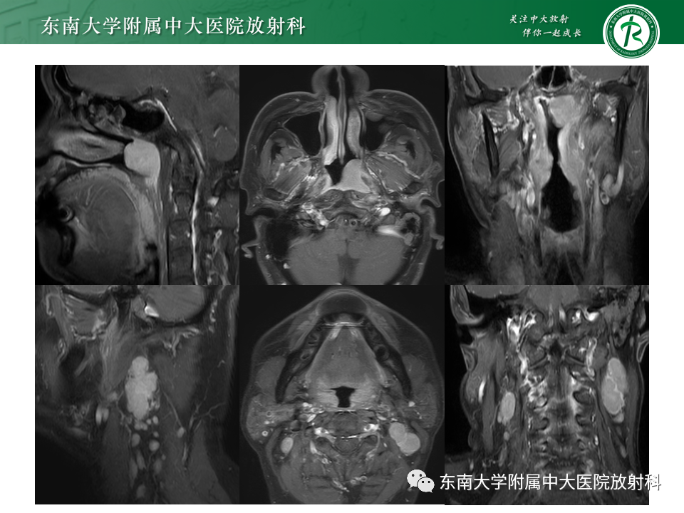 影像PPT - 【PPT】鼻咽部占位性病变随访及鉴别-12