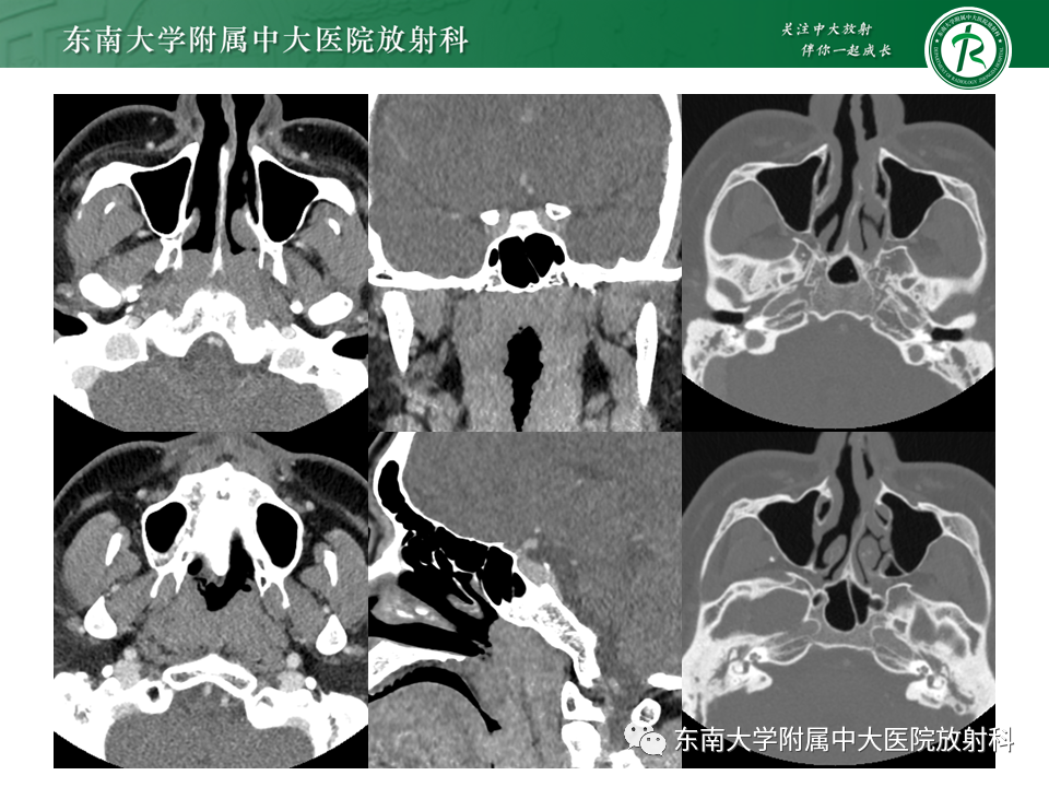 影像PPT - 【PPT】鼻咽部占位性病变随访及鉴别-15