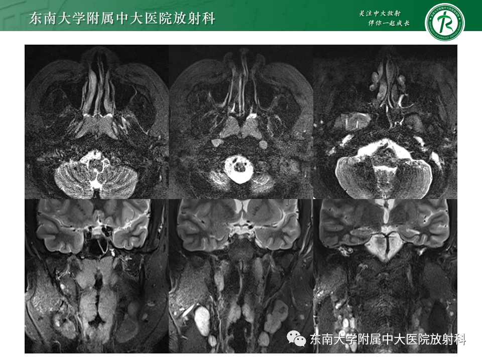 影像PPT - 【PPT】鼻咽部占位性病变随访及鉴别-16