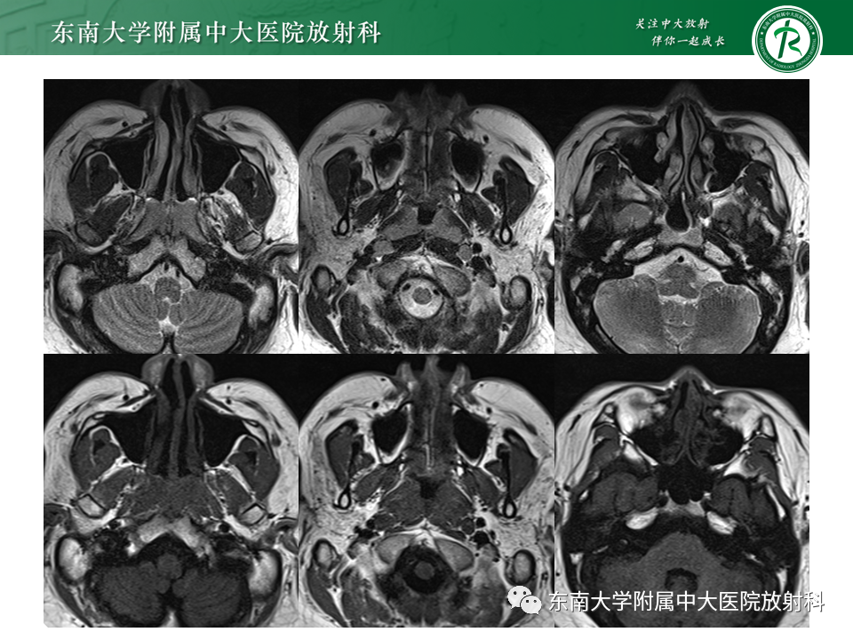 影像PPT - 【PPT】鼻咽部占位性病变随访及鉴别-17
