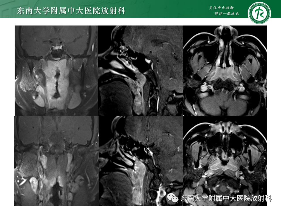 影像PPT - 【PPT】鼻咽部占位性病变随访及鉴别-19