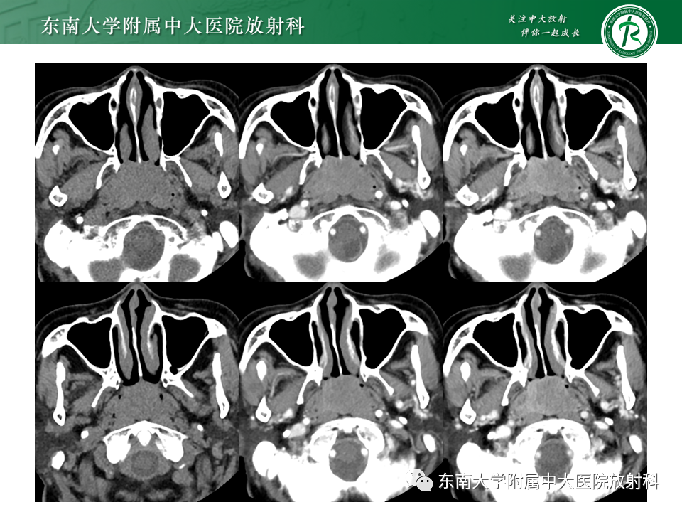 影像PPT - 【PPT】鼻咽部占位性病变随访及鉴别-21