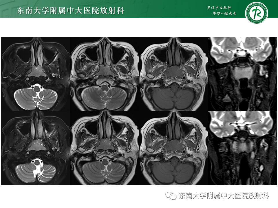 影像PPT - 【PPT】鼻咽部占位性病变随访及鉴别-22