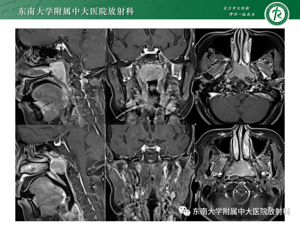 影像PPT - 【PPT】鼻咽部占位性病变随访及鉴别-24