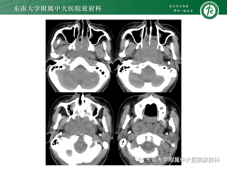 影像PPT - 【PPT】鼻咽部占位性病变随访及鉴别-26