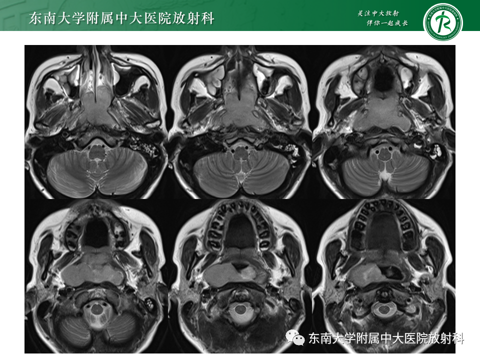 影像PPT - 【PPT】鼻咽部占位性病变随访及鉴别-27
