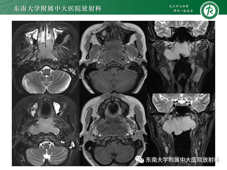 影像PPT - 【PPT】鼻咽部占位性病变随访及鉴别-28