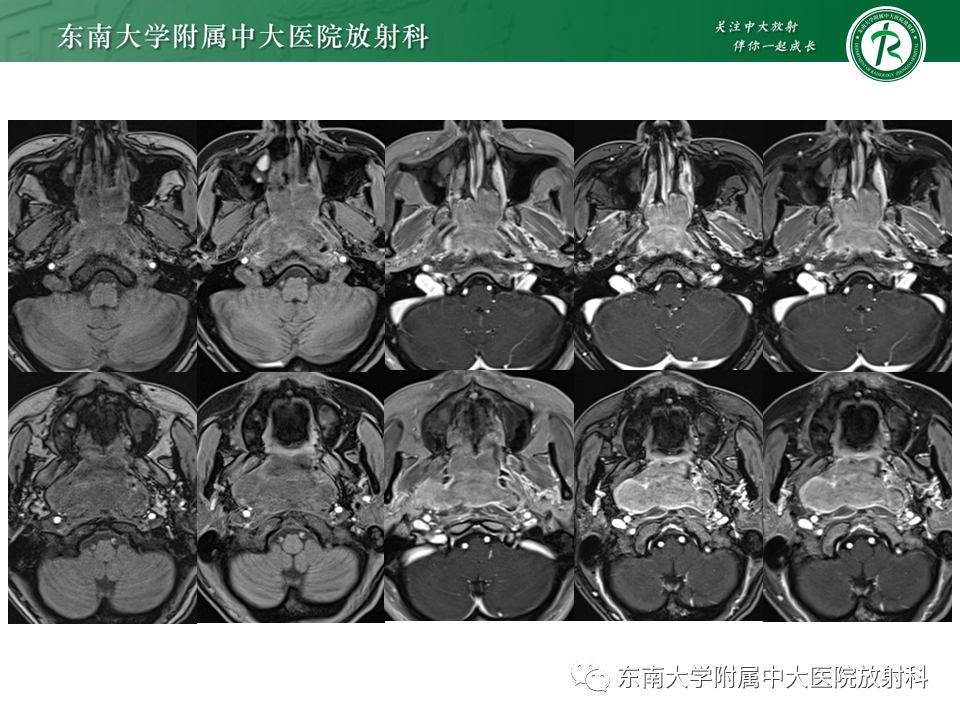 影像PPT - 【PPT】鼻咽部占位性病变随访及鉴别-30