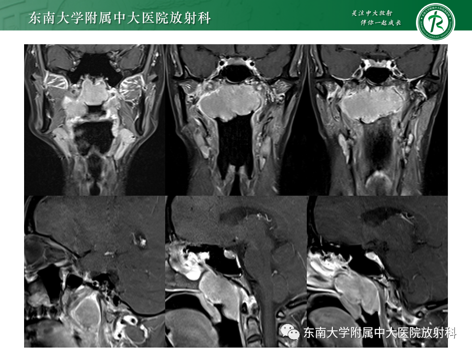 影像PPT - 【PPT】鼻咽部占位性病变随访及鉴别-31