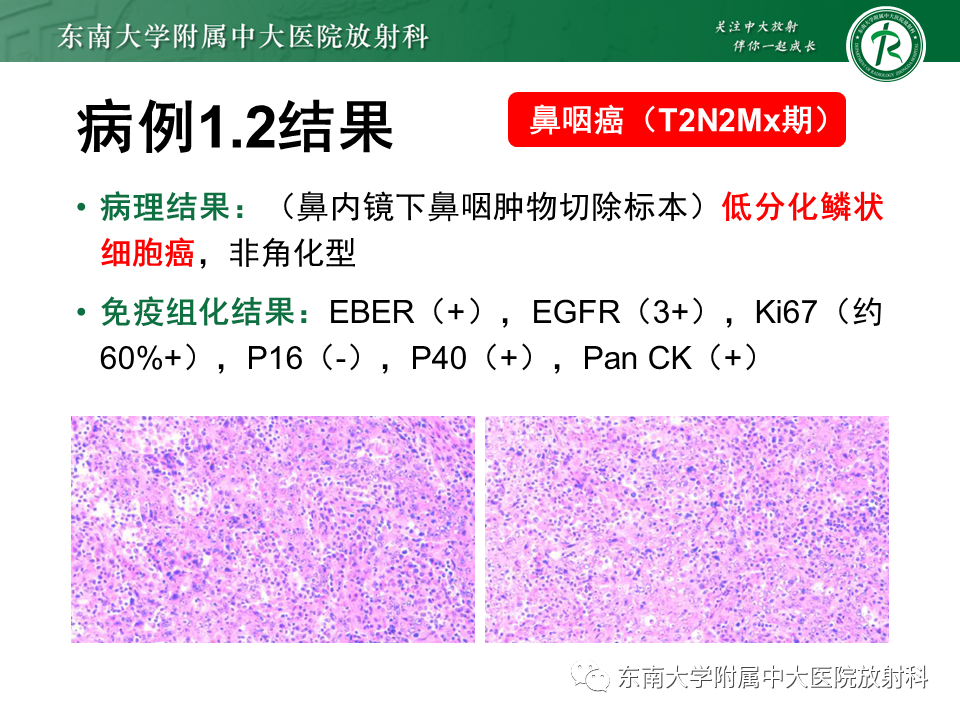 影像PPT - 【PPT】鼻咽部占位性病变随访及鉴别-33