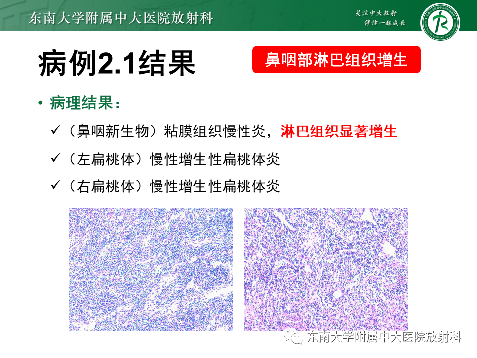 影像PPT - 【PPT】鼻咽部占位性病变随访及鉴别-34