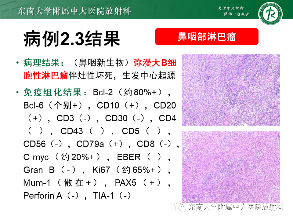 影像PPT - 【PPT】鼻咽部占位性病变随访及鉴别-36