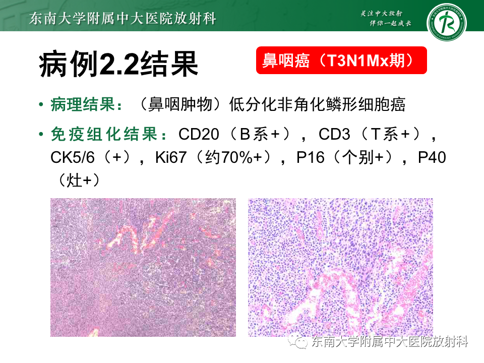 影像PPT - 【PPT】鼻咽部占位性病变随访及鉴别-35