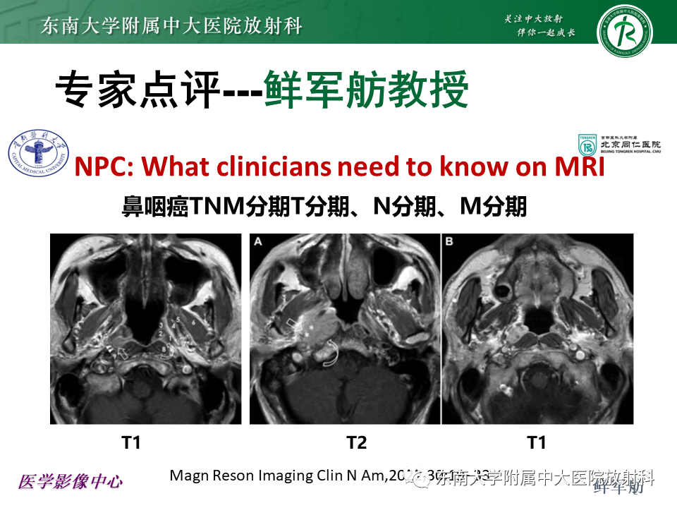 影像PPT - 【PPT】鼻咽部占位性病变随访及鉴别-39