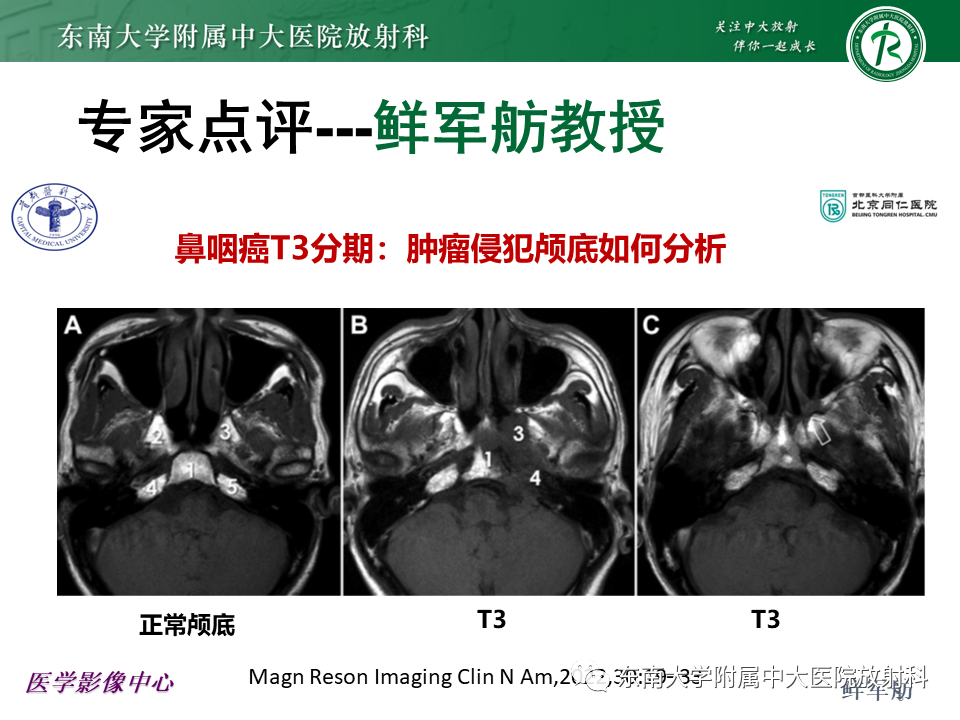 影像PPT - 【PPT】鼻咽部占位性病变随访及鉴别-40