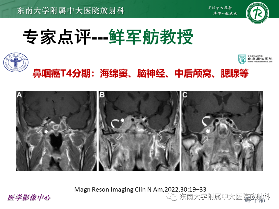 影像PPT - 【PPT】鼻咽部占位性病变随访及鉴别-41