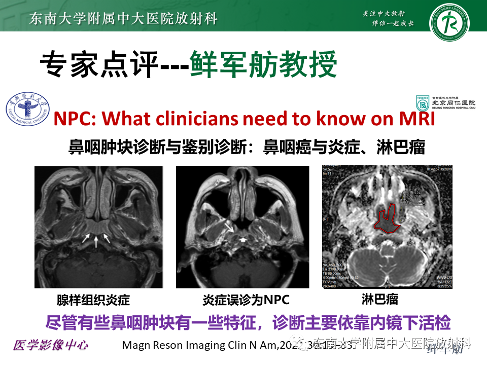 影像PPT - 【PPT】鼻咽部占位性病变随访及鉴别-42
