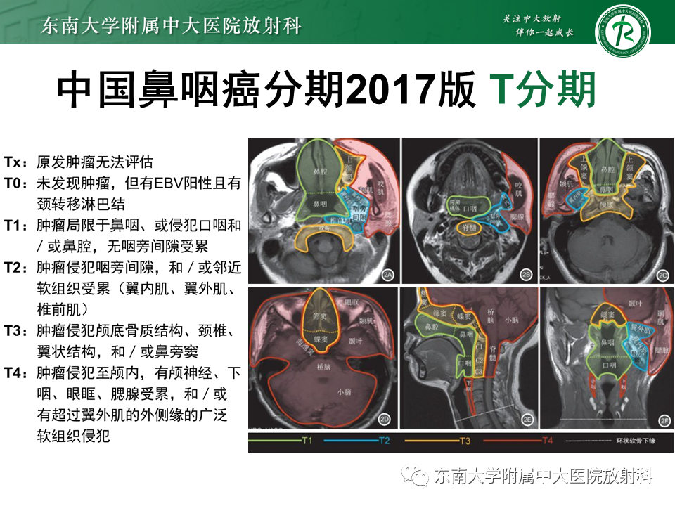 影像PPT - 【PPT】鼻咽部占位性病变随访及鉴别-57