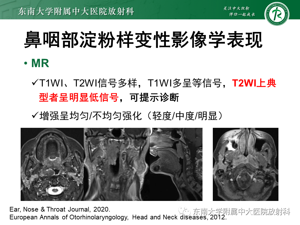 影像PPT - 【PPT】鼻咽部占位性病变随访及鉴别-66